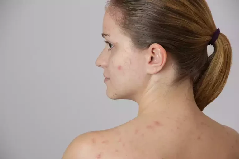 ¿Has escuchado del acné quístico?